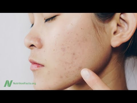 Saving Lives by Treating Acne with Diet