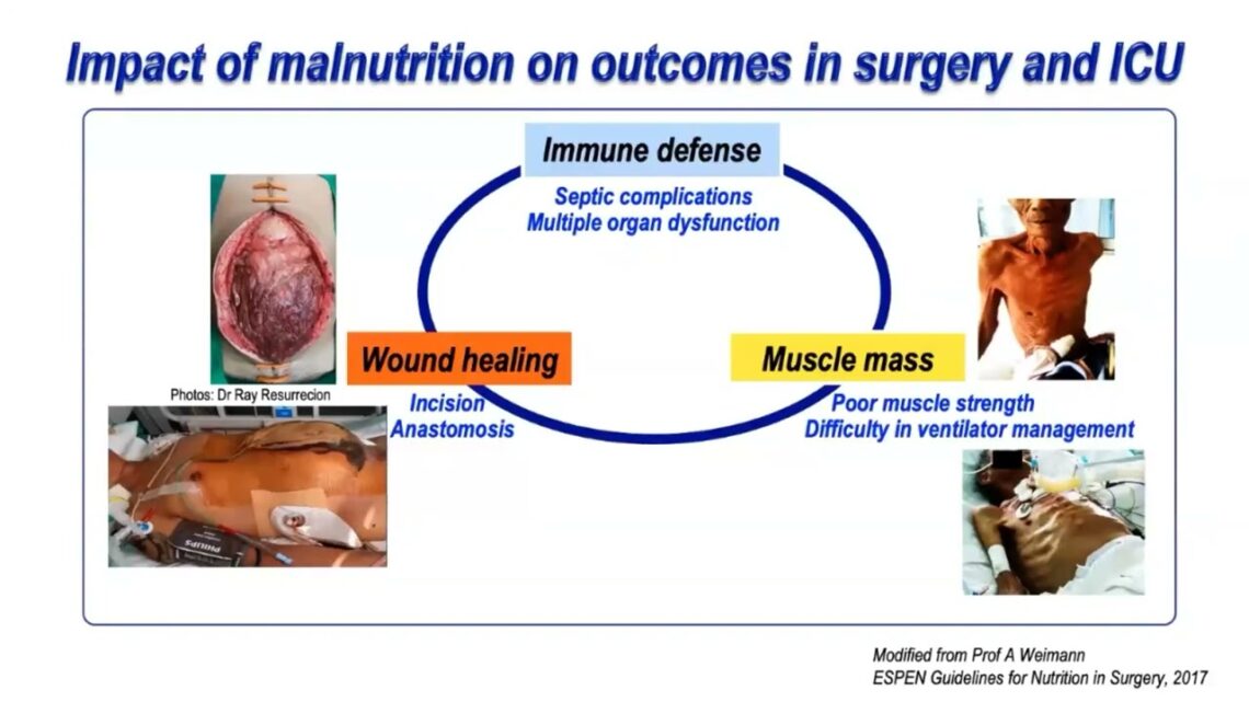 19th Indoanesthesia : Preserving the Quality of Life Nutrition Therapy for Critically Ill Patients