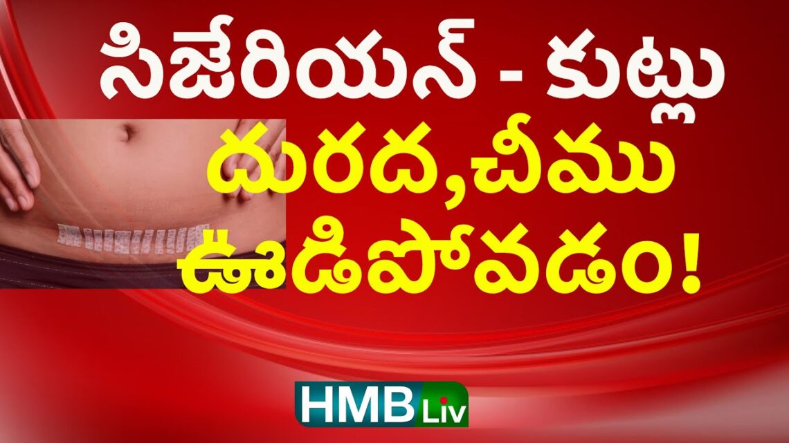 సి సెక్షన్ కుట్లు త్వరగా తగ్గాలంటే? చీము, దురద, ఊడిపోవడం? fast recovery C section in telugu HMBLiv