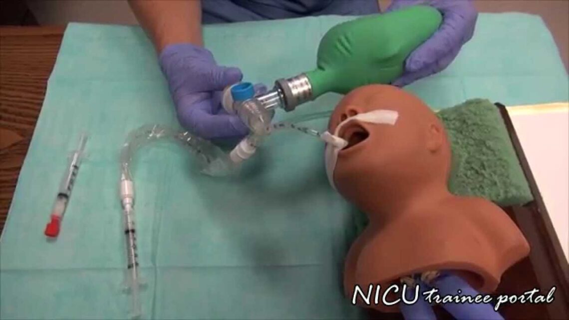 NICU Procedures- Surfactant administration in a preterm infant