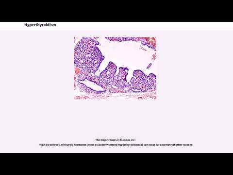 Hyperthyroidism