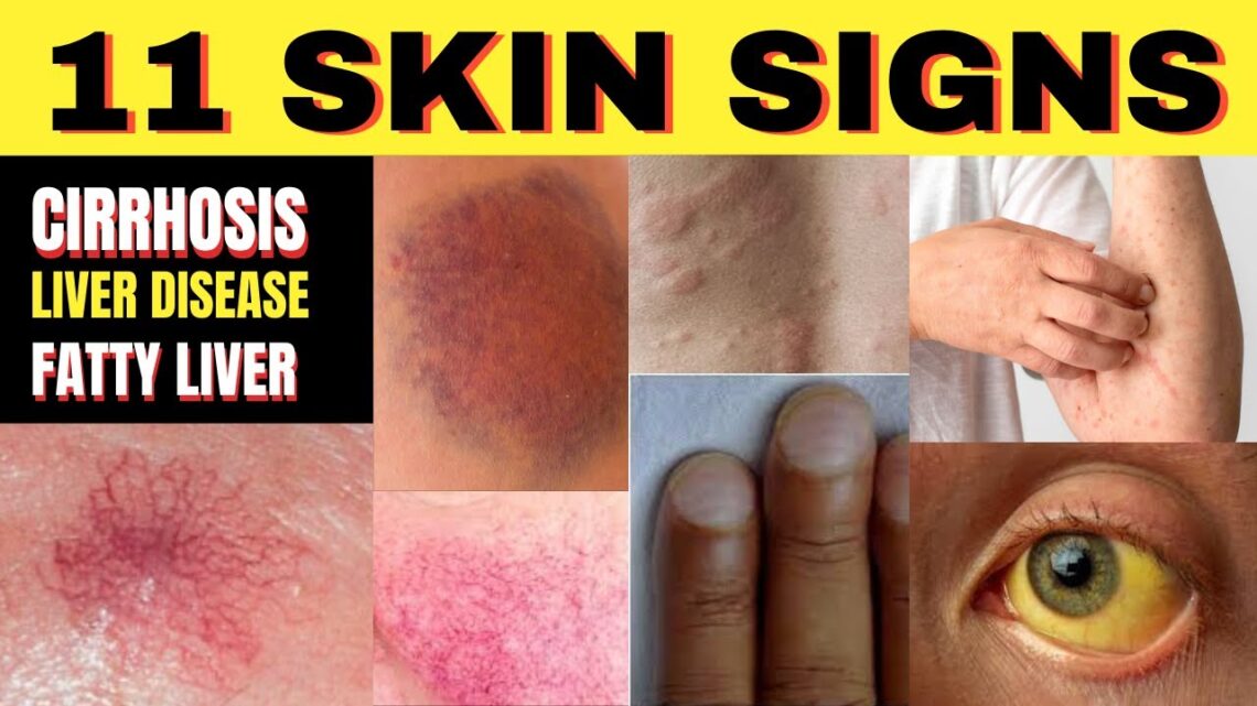 ⚠️ 11 Skin Signs of Cirrhosis Liver Disease & Fatty Liver | Longevity Deprocessed