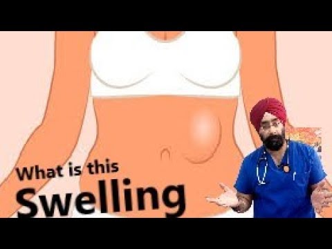 Most common cause of Abdominal Swelling Explained | LUMP in Abdomen | Dr.Education (Eng)