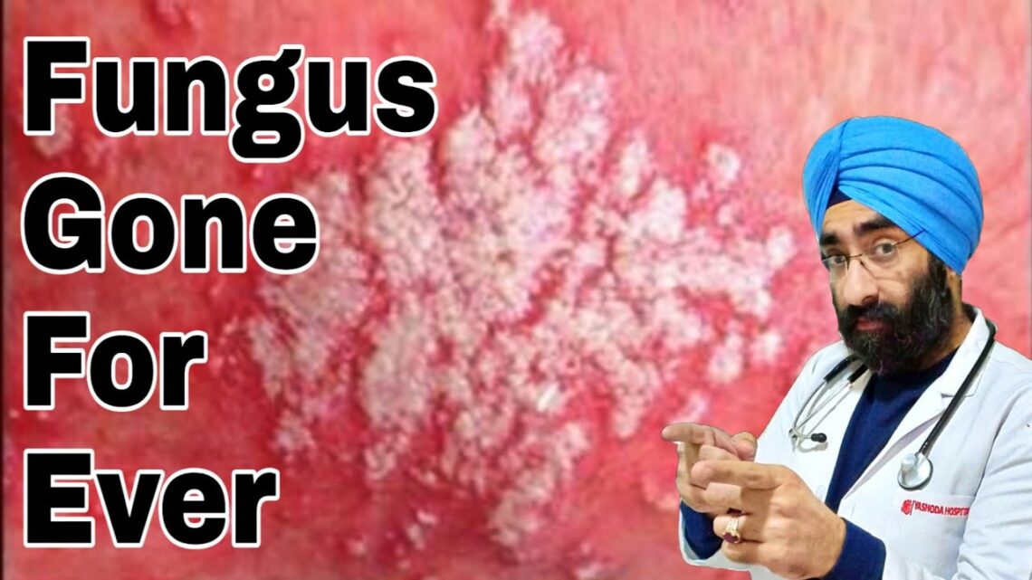 Fungal Infection ka sahi ilaaj | 100% CURE | Dr.Education (HINDI)