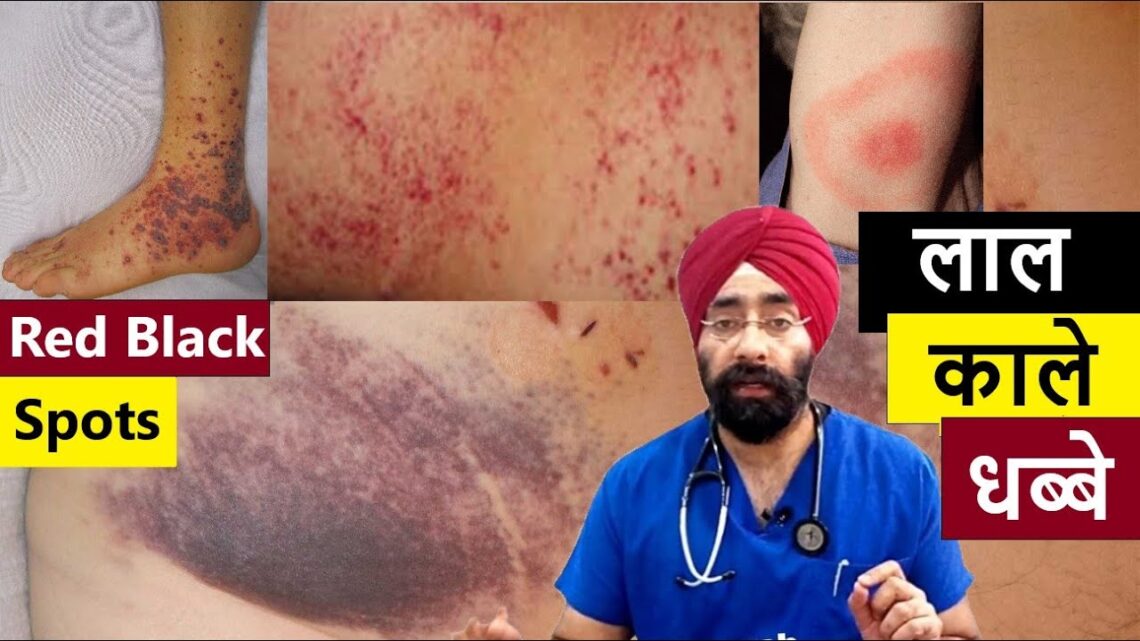 Red Black Spots on the Skin | चमड़ी पे लाल काले धब्बे | Dr.Education