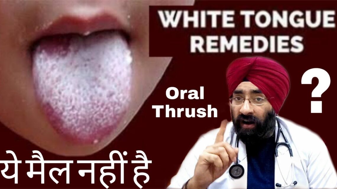 ज़बान पर सफ़ेद दाने | ORAL THRUSH | White Tongue is a Fungus | How to Cure by Dr.Education (Hindi)