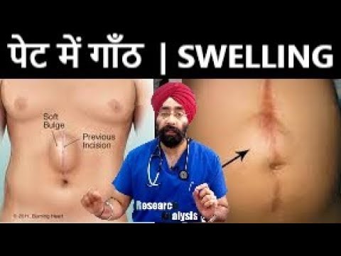 पेट में गाँठ  | LUMP IN ABDOMEN | Swelling over Stomach Explained by Dr.Education (Hindi)