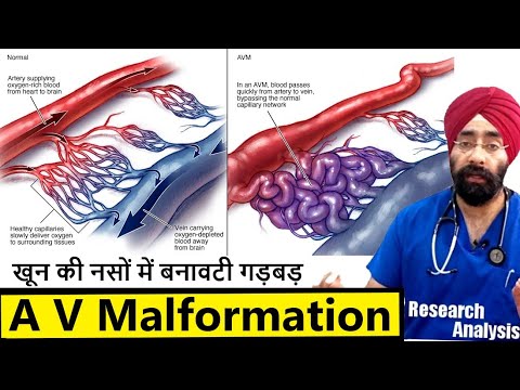 What are AV Malformations | खून की नसों में बनावटी गड़बड़  | Dr.Education