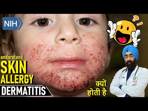 SKIN ALLERGY क्यों होती है | ATOPIC DERMATITIS | ECZEMA | RASH | Dr.Education Hindi Eng