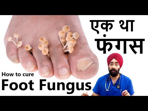 एक था फंगस का इलाज | How to cure Fungus on your feet | athletes foot | Dr.Education