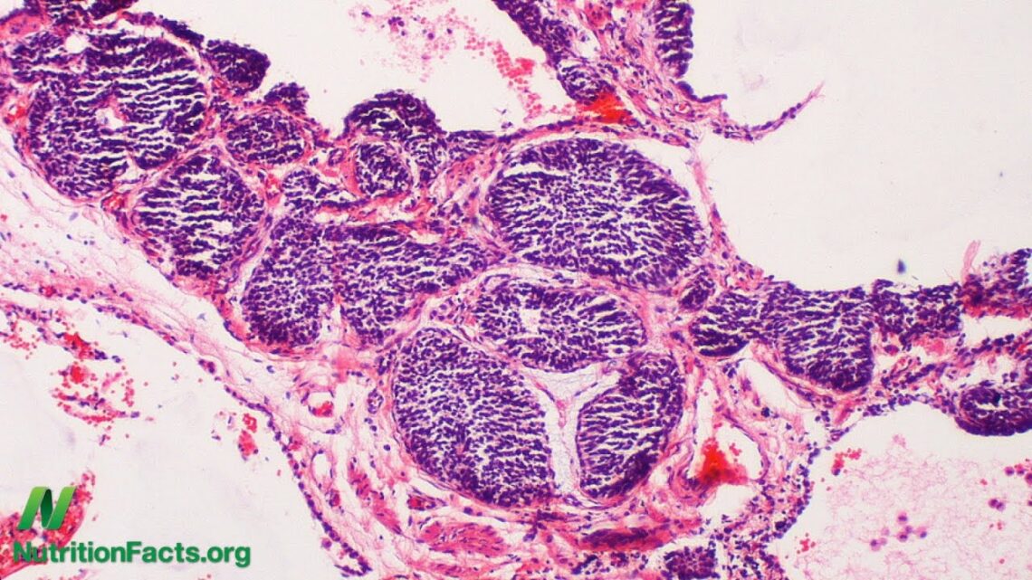 How Tumors Use Meat to Grow: Xeno-Autoantibodies