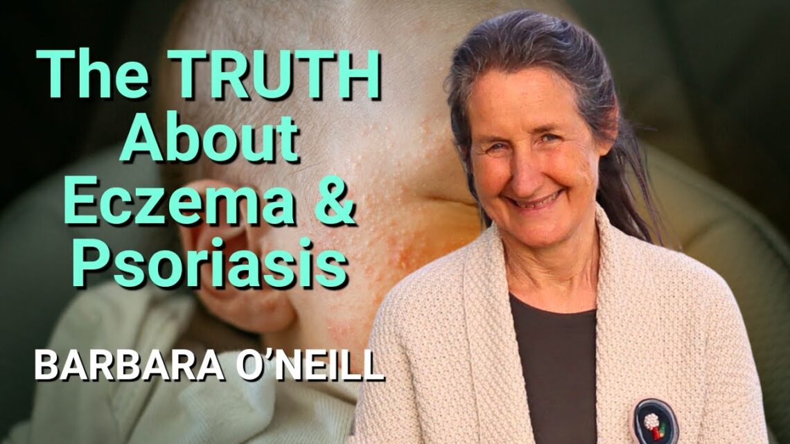 Barbara O’Neill reveals the TRUTH about Eczema & Psoriasis #barbaraoneill