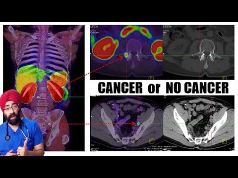 PET CT Scan can detect any and all CANCER in your Body | Dr.Education