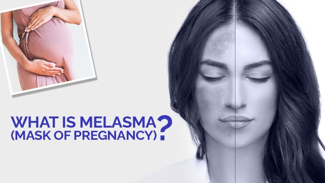 What is Melasma (Mask of Pregnancy)? | Melasma Causes and Treatment Explained | 3D Animation