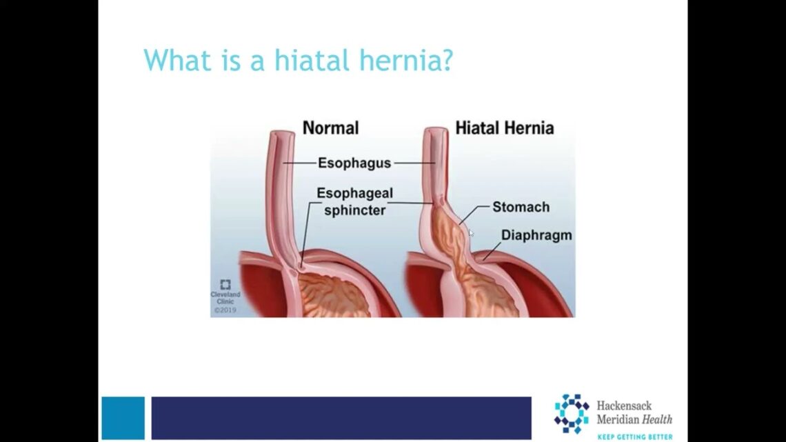 GERD and Hiatal Hernia | Annie Benzie, M.D.